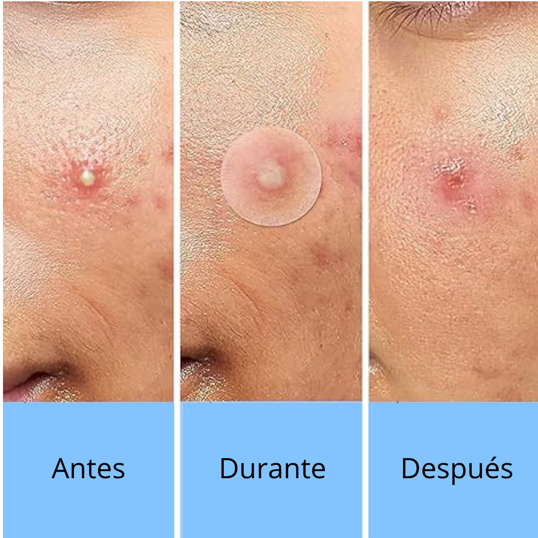 [ 2 X 1 ] ACNE PATCH INVISIBLES + PATCH CON FORMAS DE REGALO