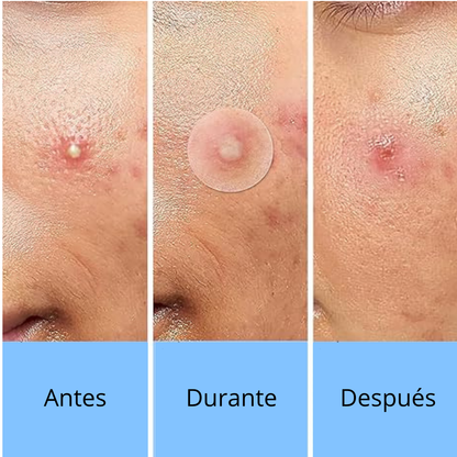 [ 2 X 1 ] ACNE PATCH INVISIBLES + PATCH CON FORMAS DE REGALO